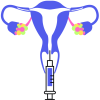 IVF PNG Image (3)